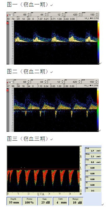 经颅多普勒超声仪tcd诊断和分析锁骨下动脉窃血程度