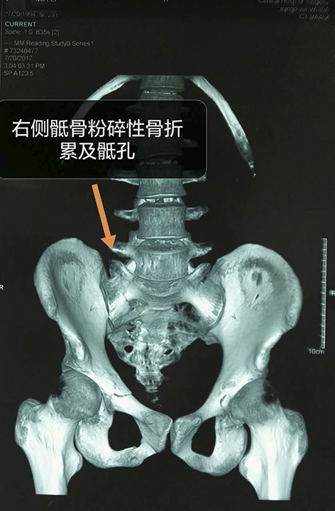 占整个骨盆功能60%,骶骨经过骶孔骨折或骶髂关节损伤的治疗效果对骨盆