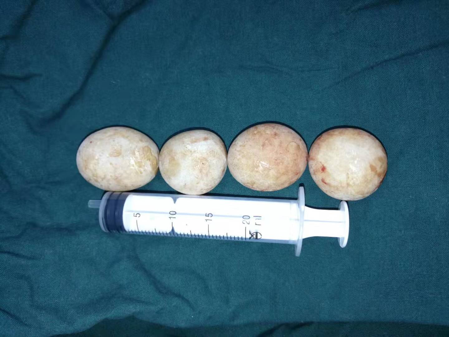 营口市中心医院成功为88岁高龄膀胱结石患者经微创手术一次性取石成功