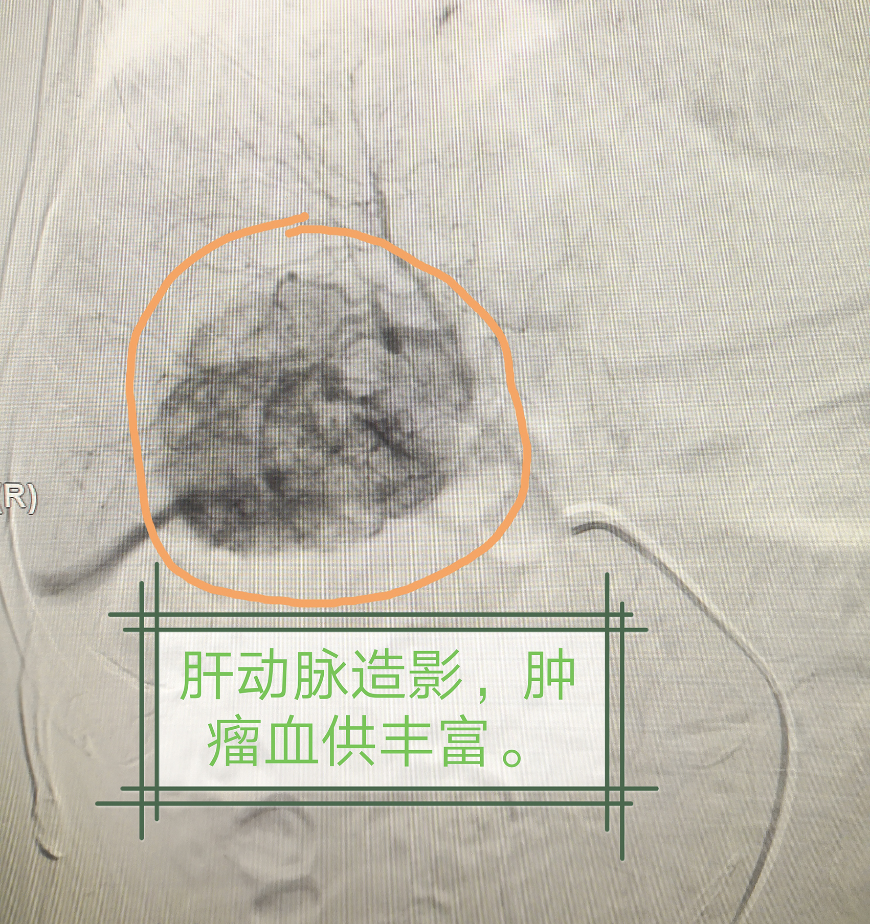 市中心医院介入治疗科采用载药微球成功治疗肝脏肿瘤 填补历史空白