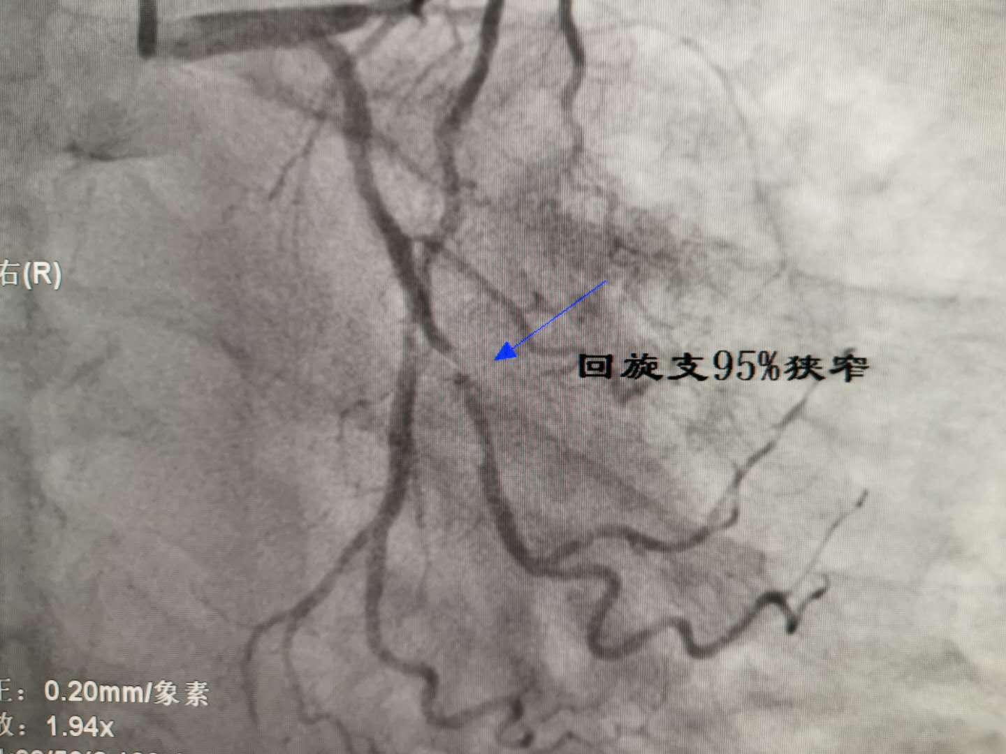 市中心医院多学科协作显神威 成功救治尿毒症合并心梗患者 - 医院新闻
