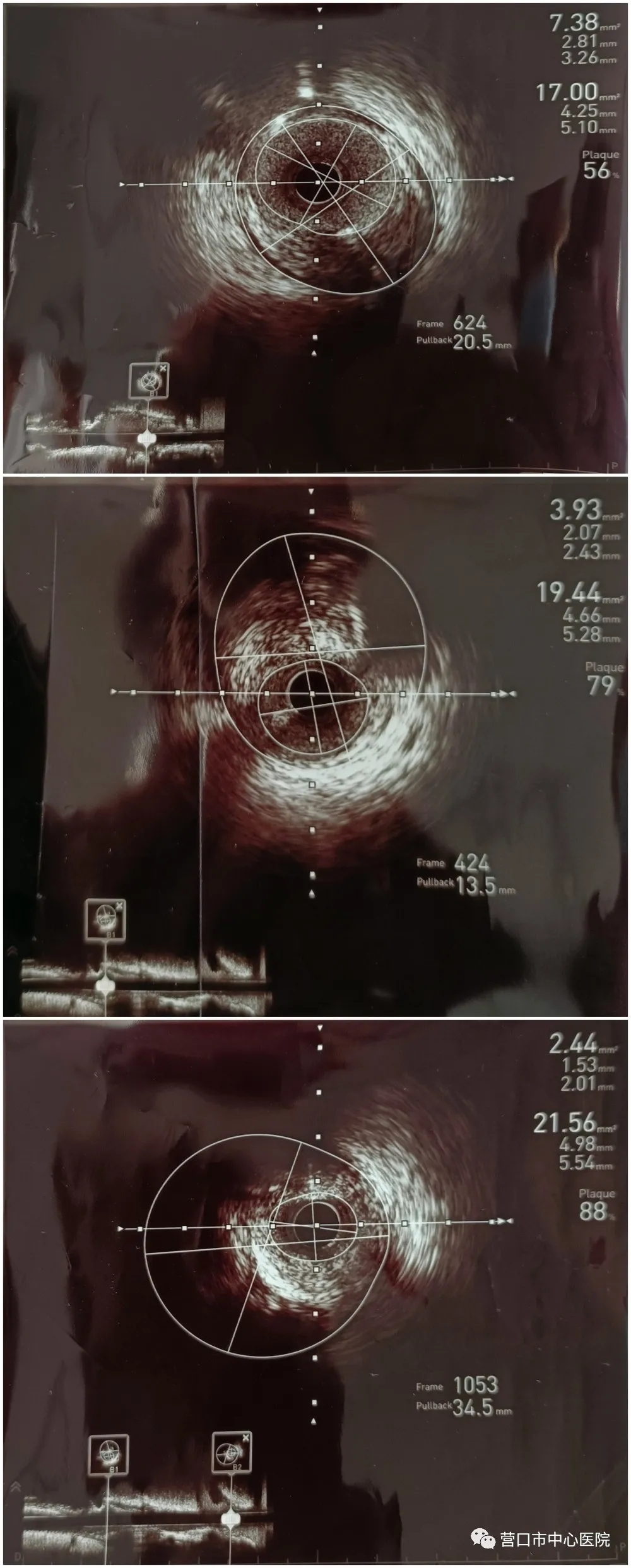 血管内超声ivus透视冠状动脉的第三只眼