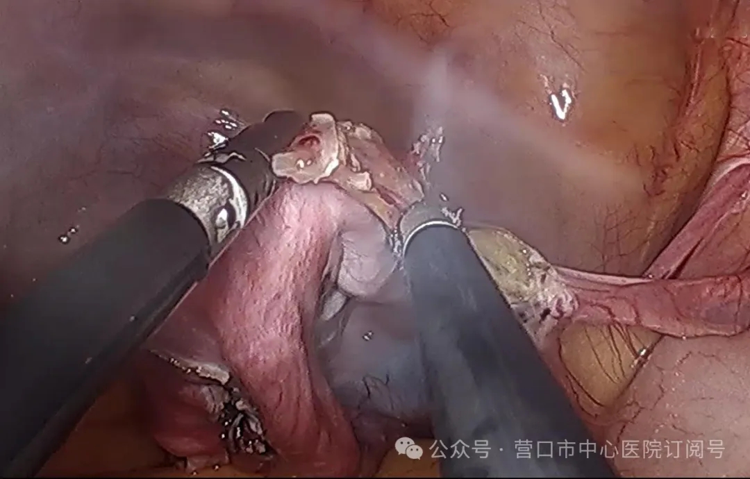 市中心医院妇科应用单孔腹腔镜 技术完成一例盆腔巨大卵巢囊肿手术
